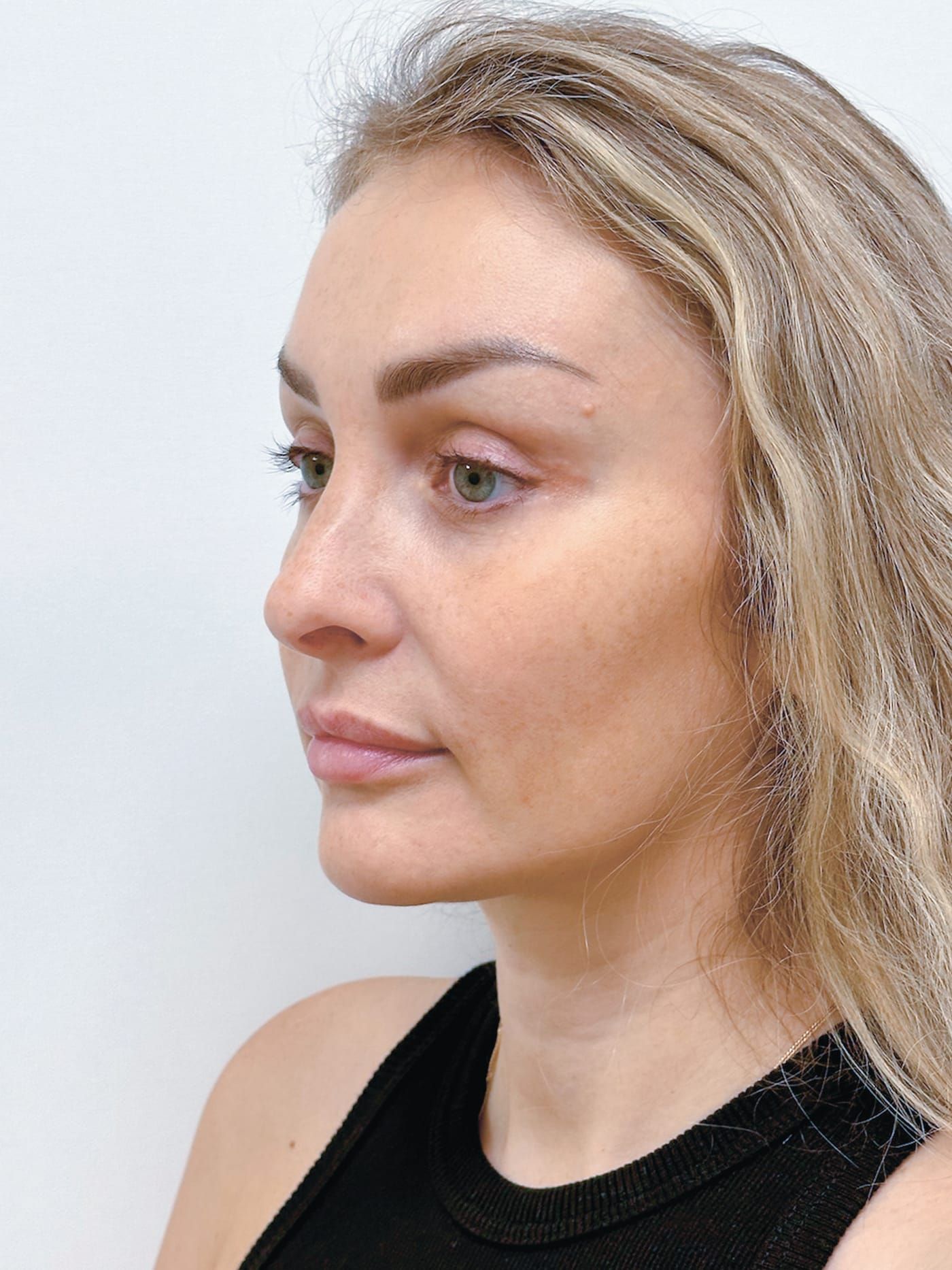 Endoscopic lift with blepharoplasty — after