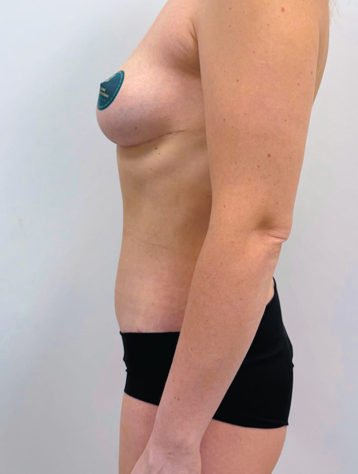 Breast lift (mastopexy) — after