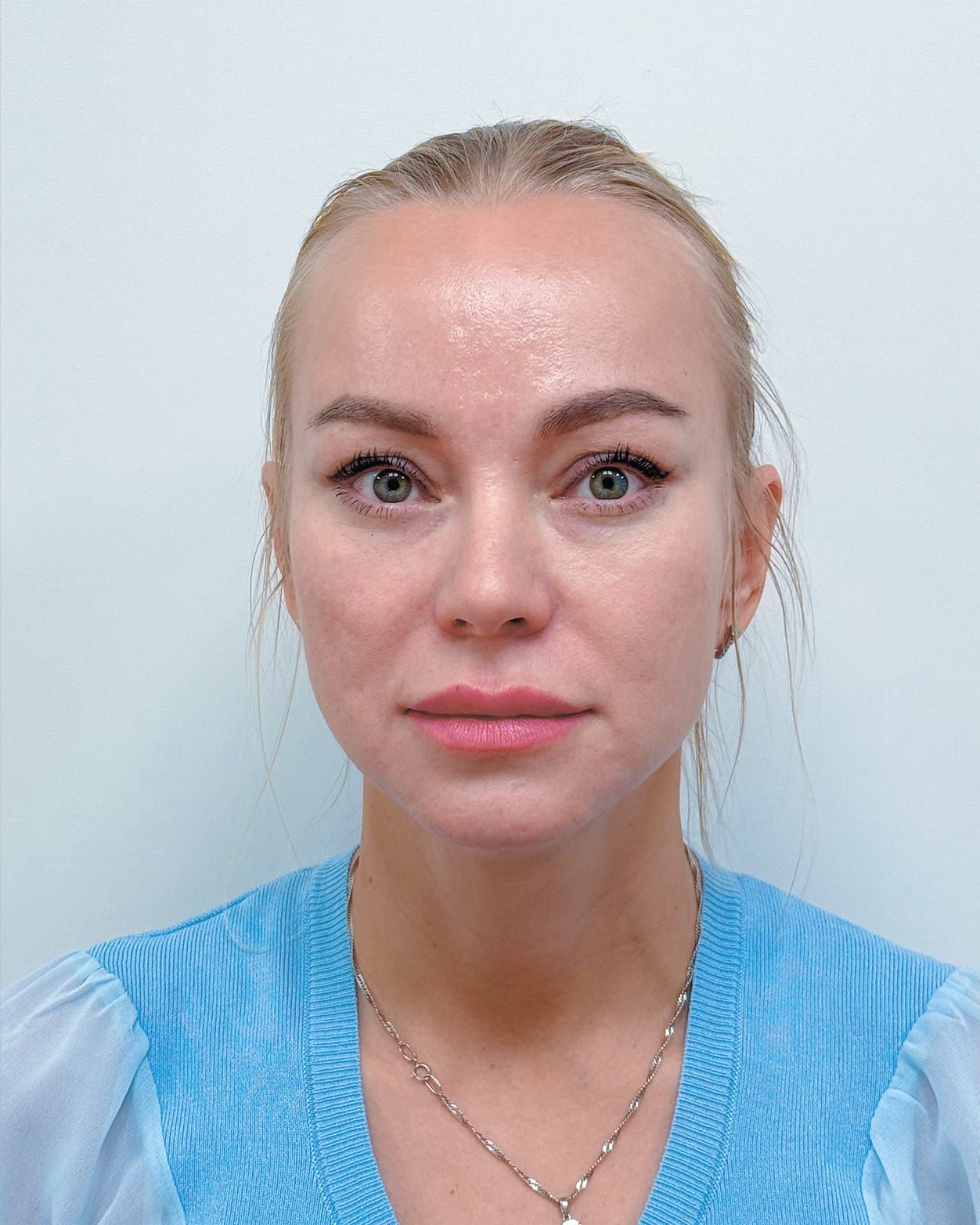 Periorbital endoscopic beautification — after