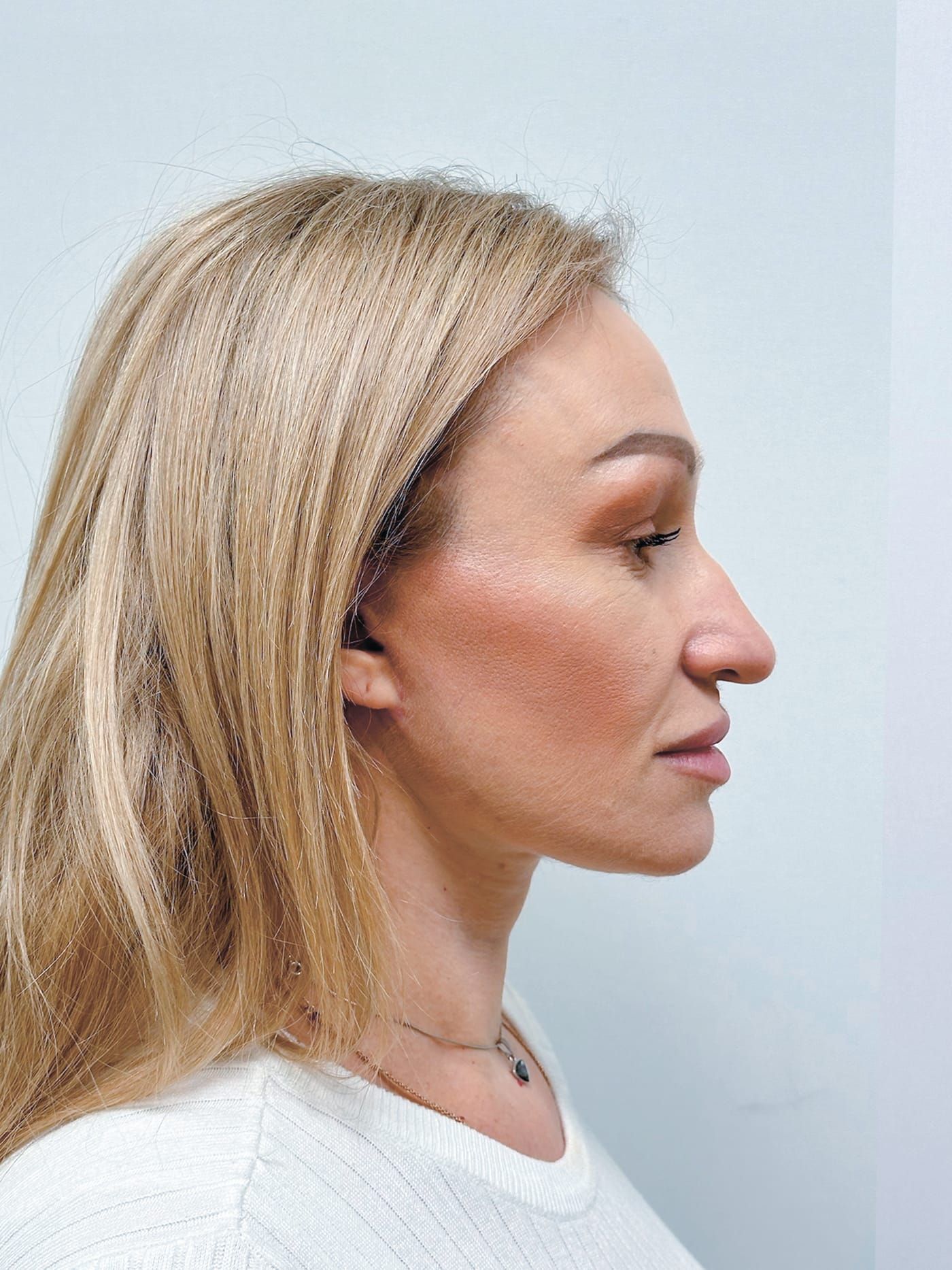 Facelift — after