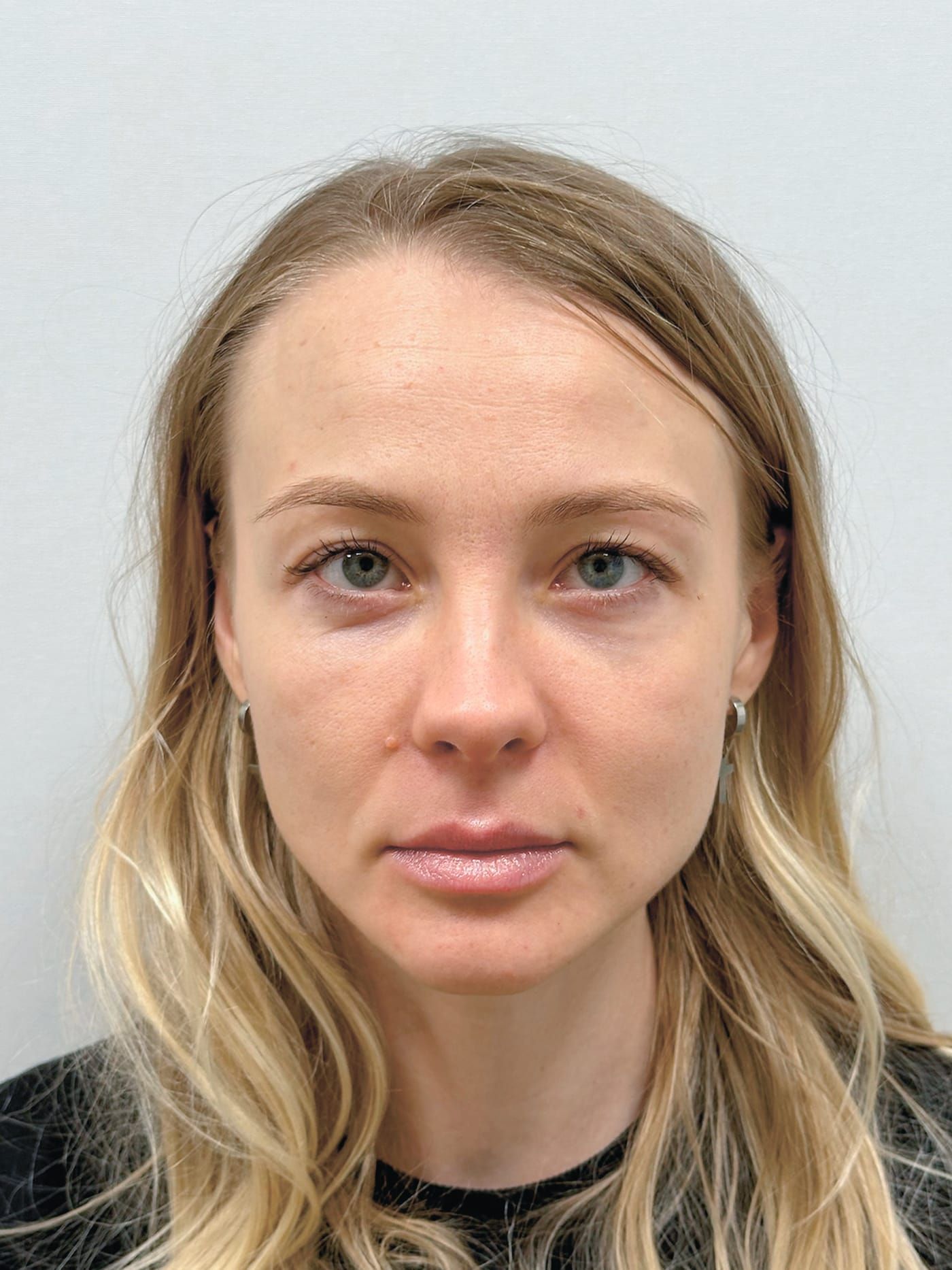 Lip augmentation — after