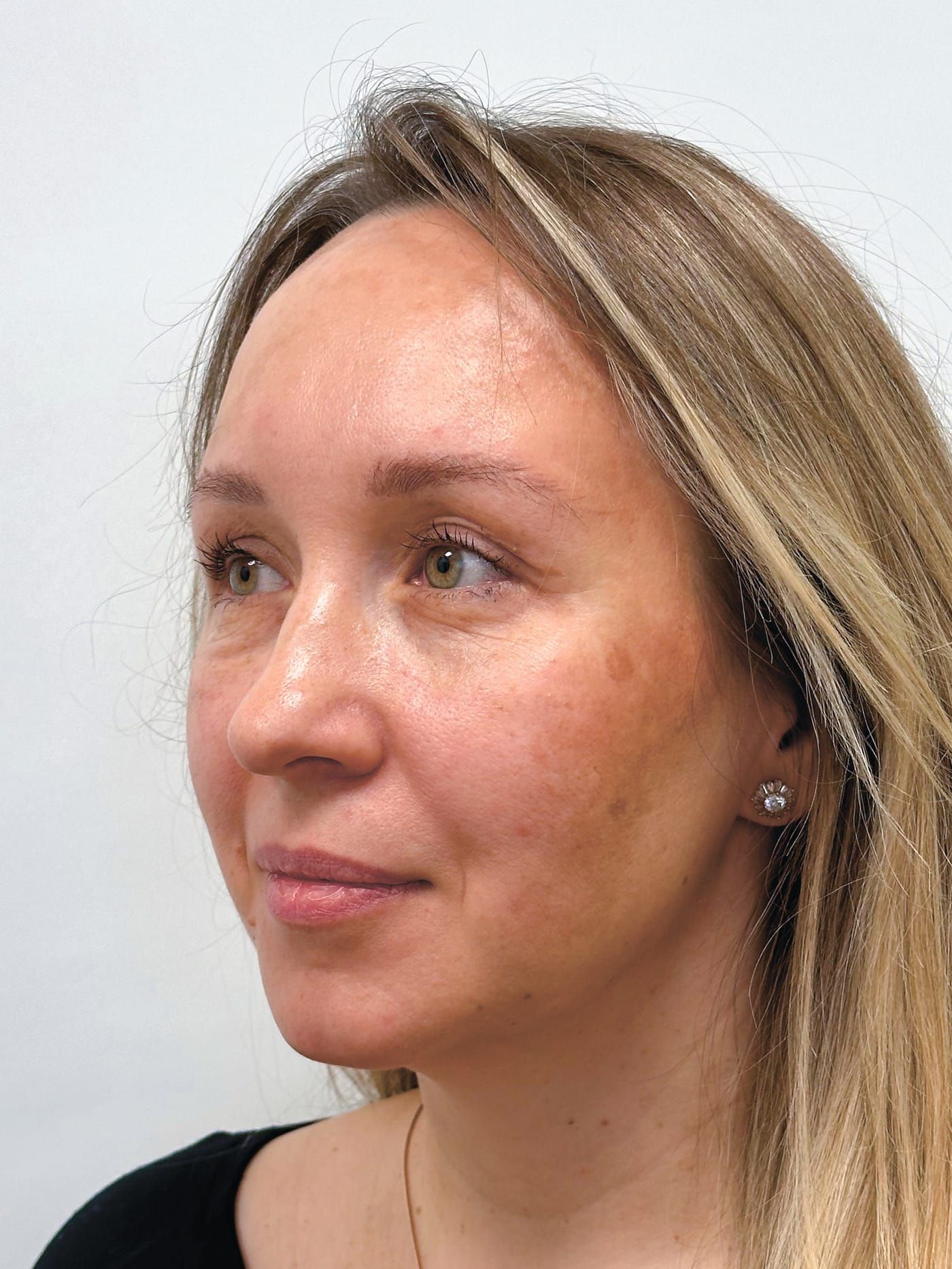 Endoscopic lift with blepharoplasty — after