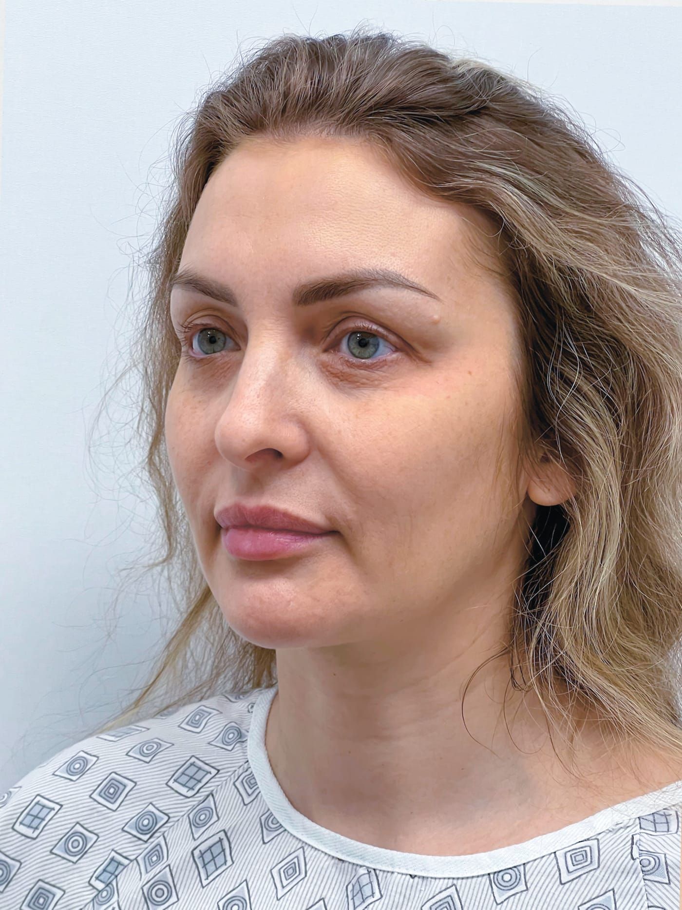 Endoscopic lift with blepharoplasty — before