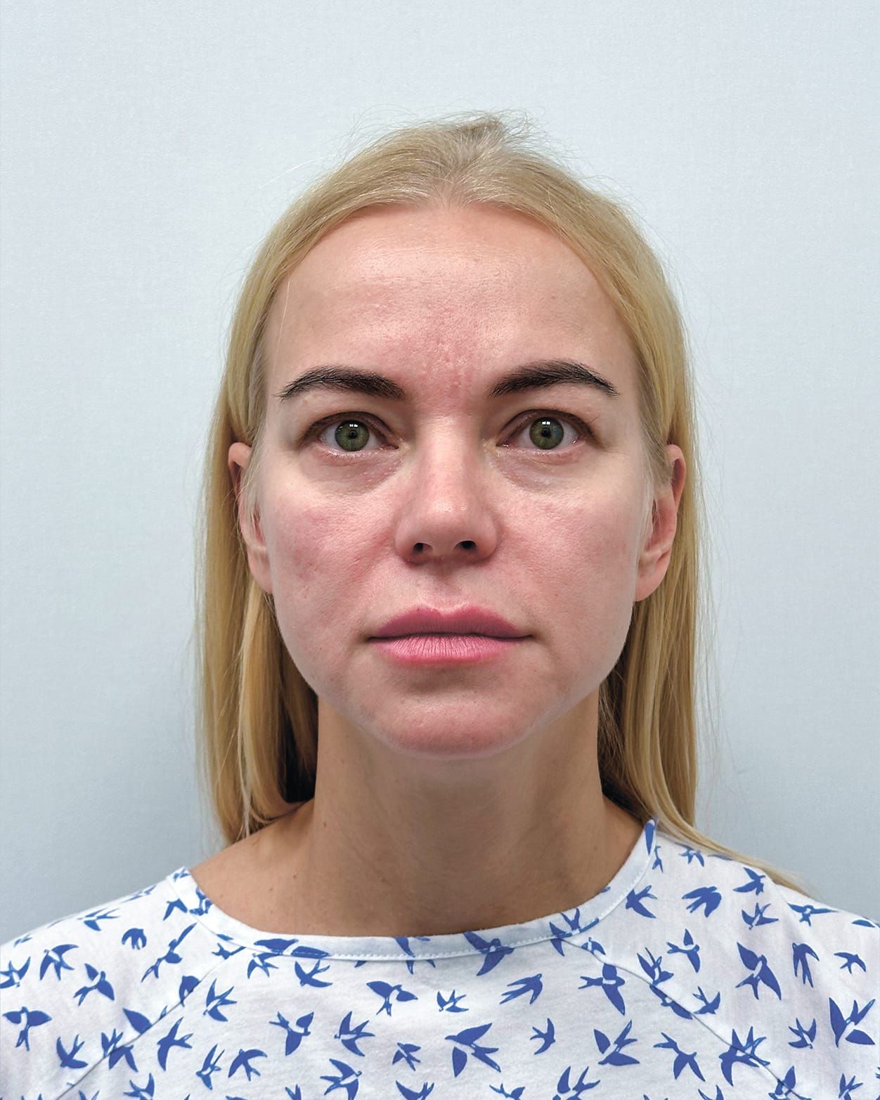 Periorbital endoscopic beautification — before