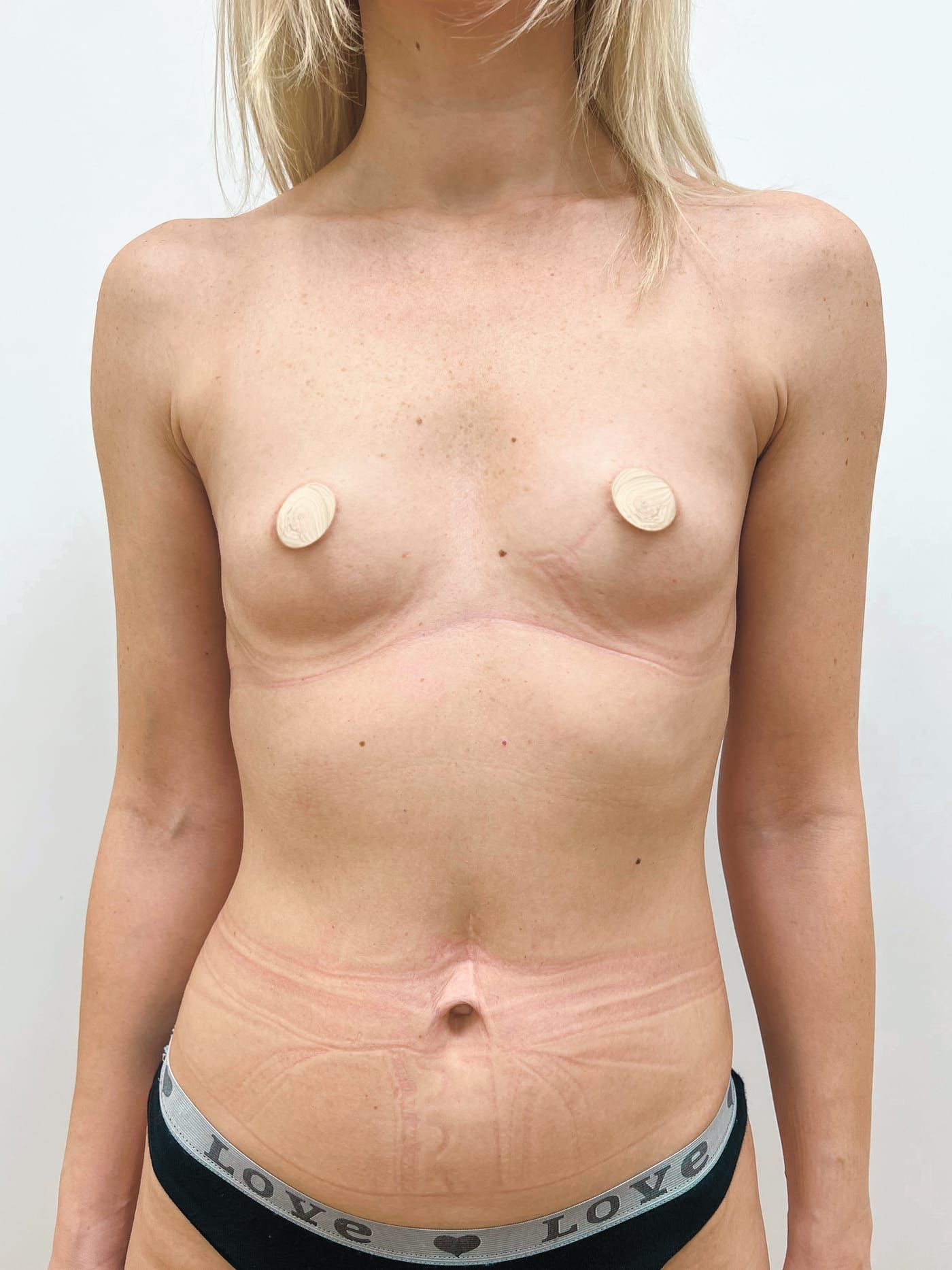 Breast augmentation — before