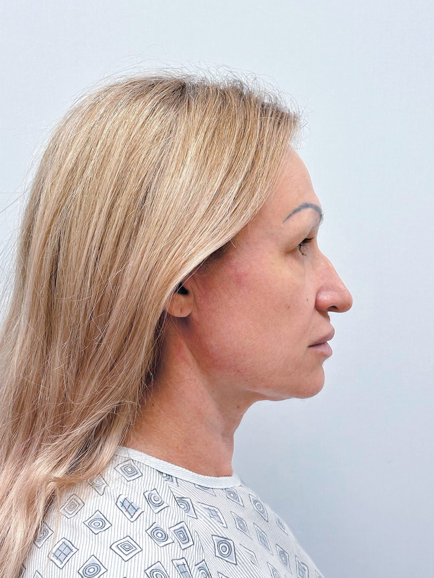 Facelift — before