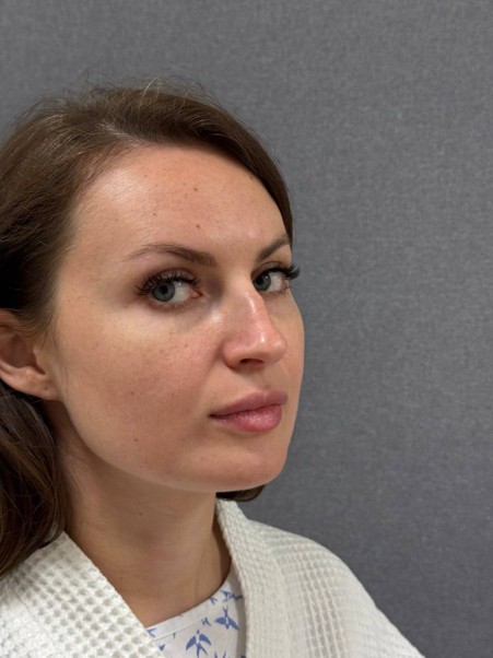 Rhinoplasty — before