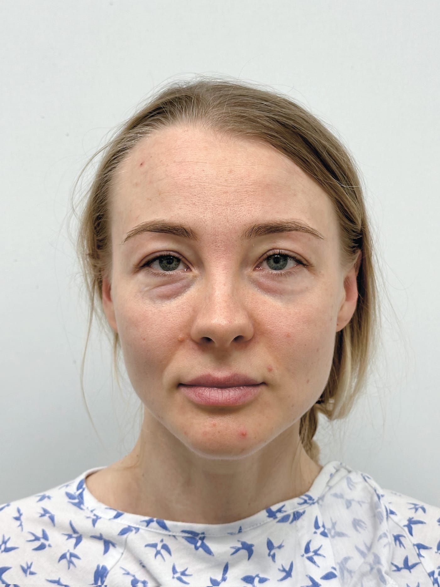Lip augmentation — before