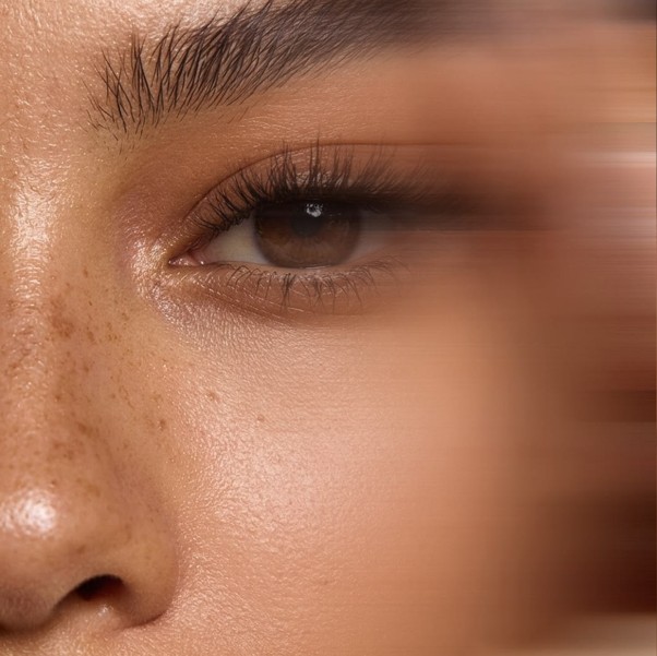 Blepharoplasty